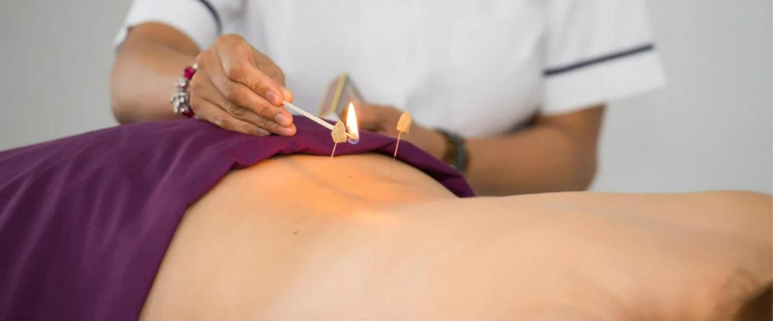 Moxibustion during an acupuncture treatment